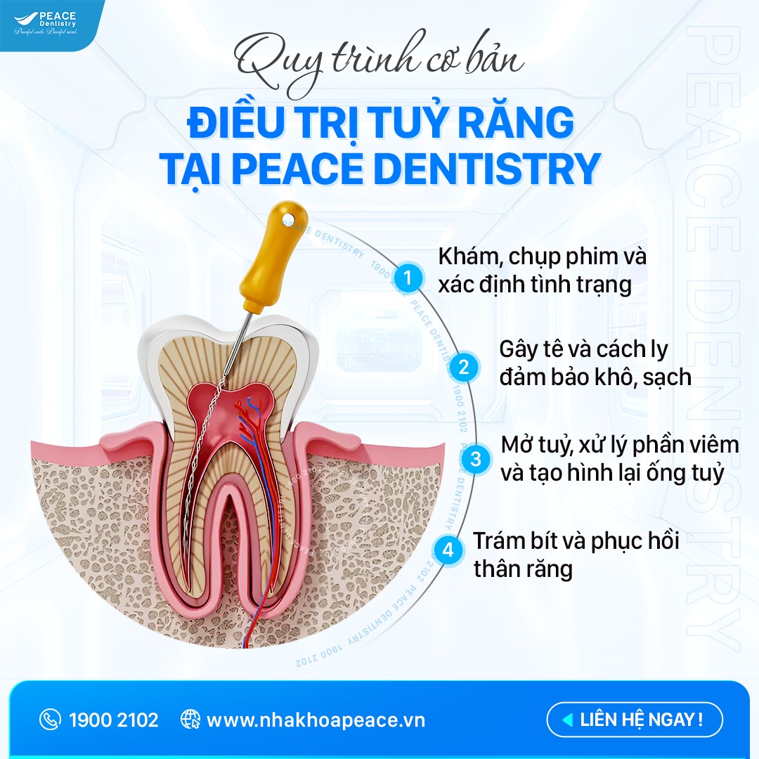 quy trình điều trị tủy răng