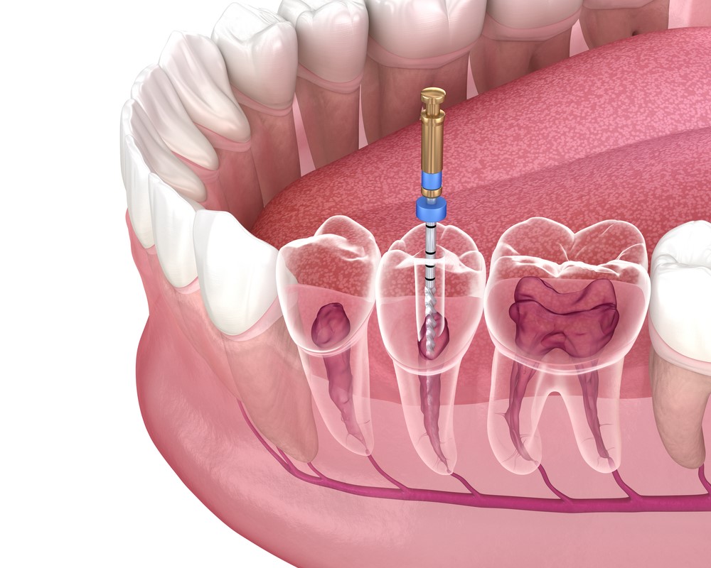 răng lấy tủy có niềng được không