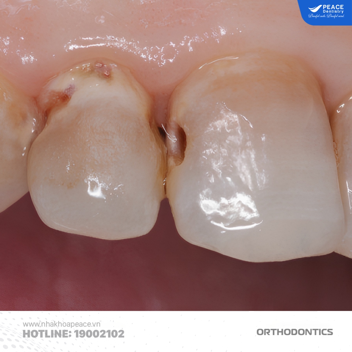 nguyên nhân gây sâu kẽ răng khi niềng