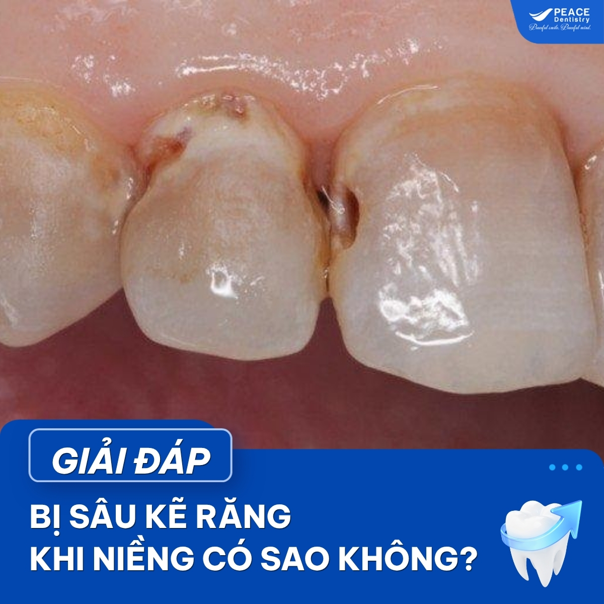 Đeo niềng bị sâu kẻ răng