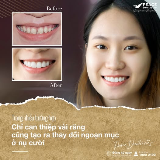 ca lâm sàng cắt nướu và dán sứ veneer