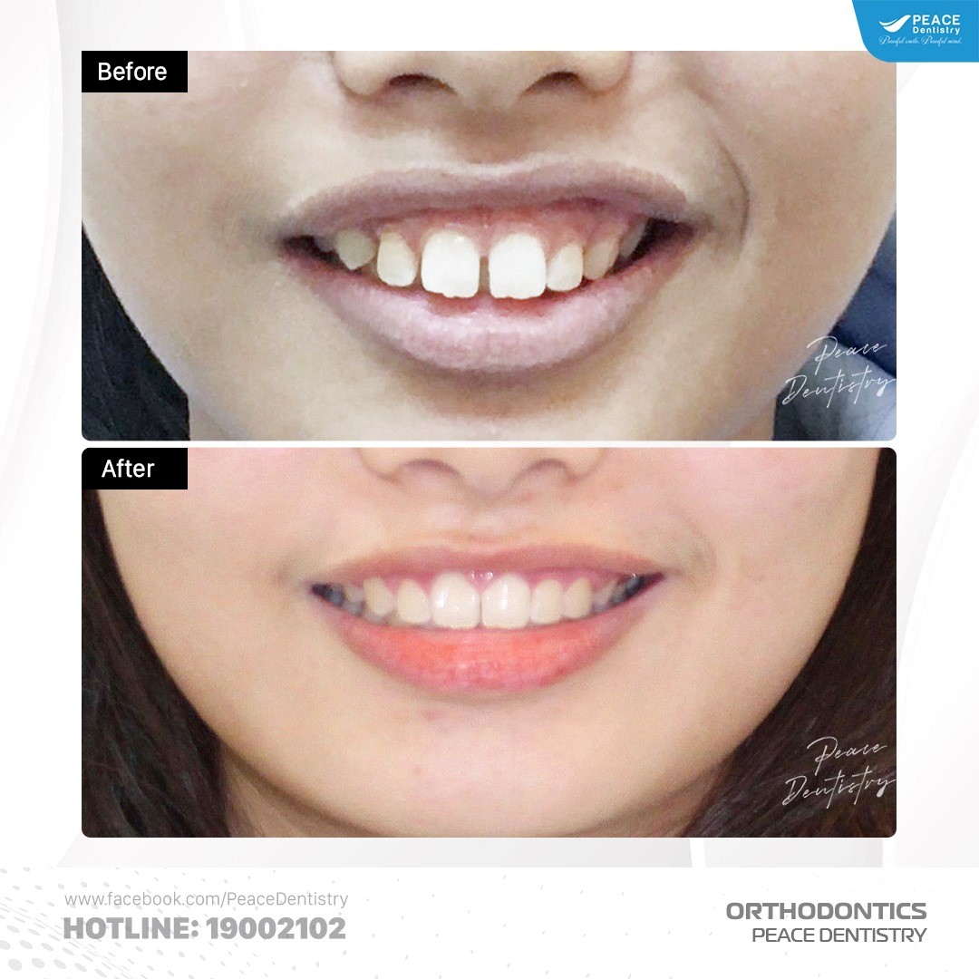 ca lâm sàng cắt nướu và niềng răng