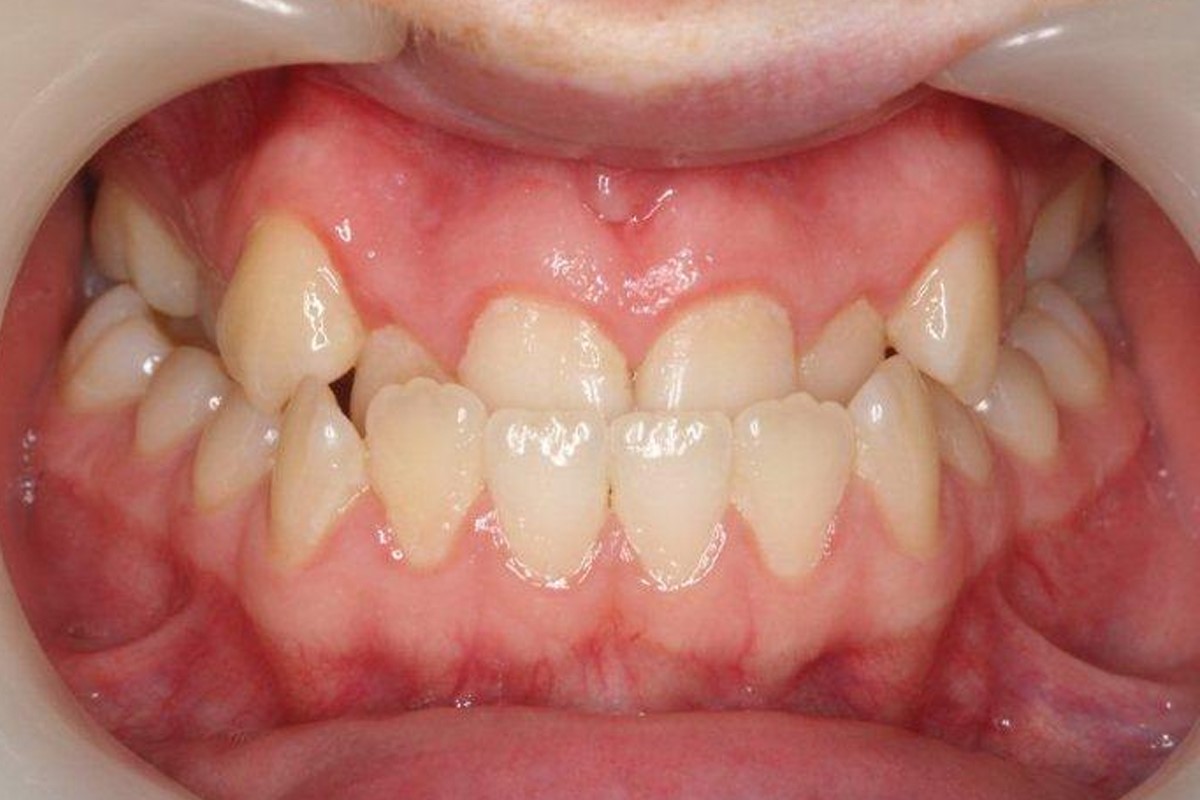 lệch khớp cắn hạng 3