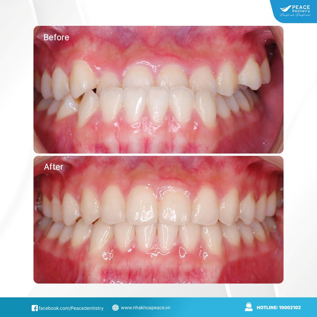 niềng răng khắc phục lệch khớp cắn hạng 3