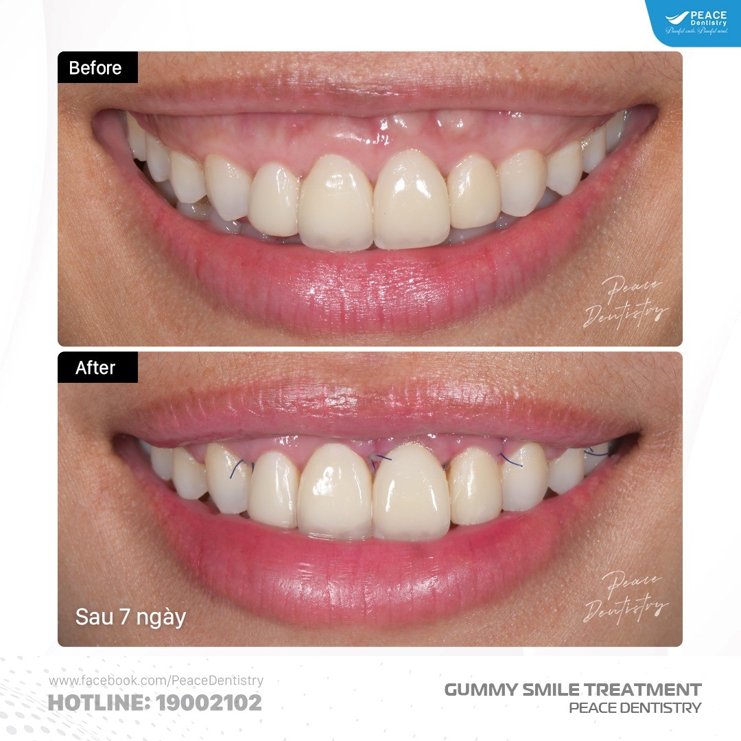 phẫu thuật cắt nướu chữa cười hở lợi