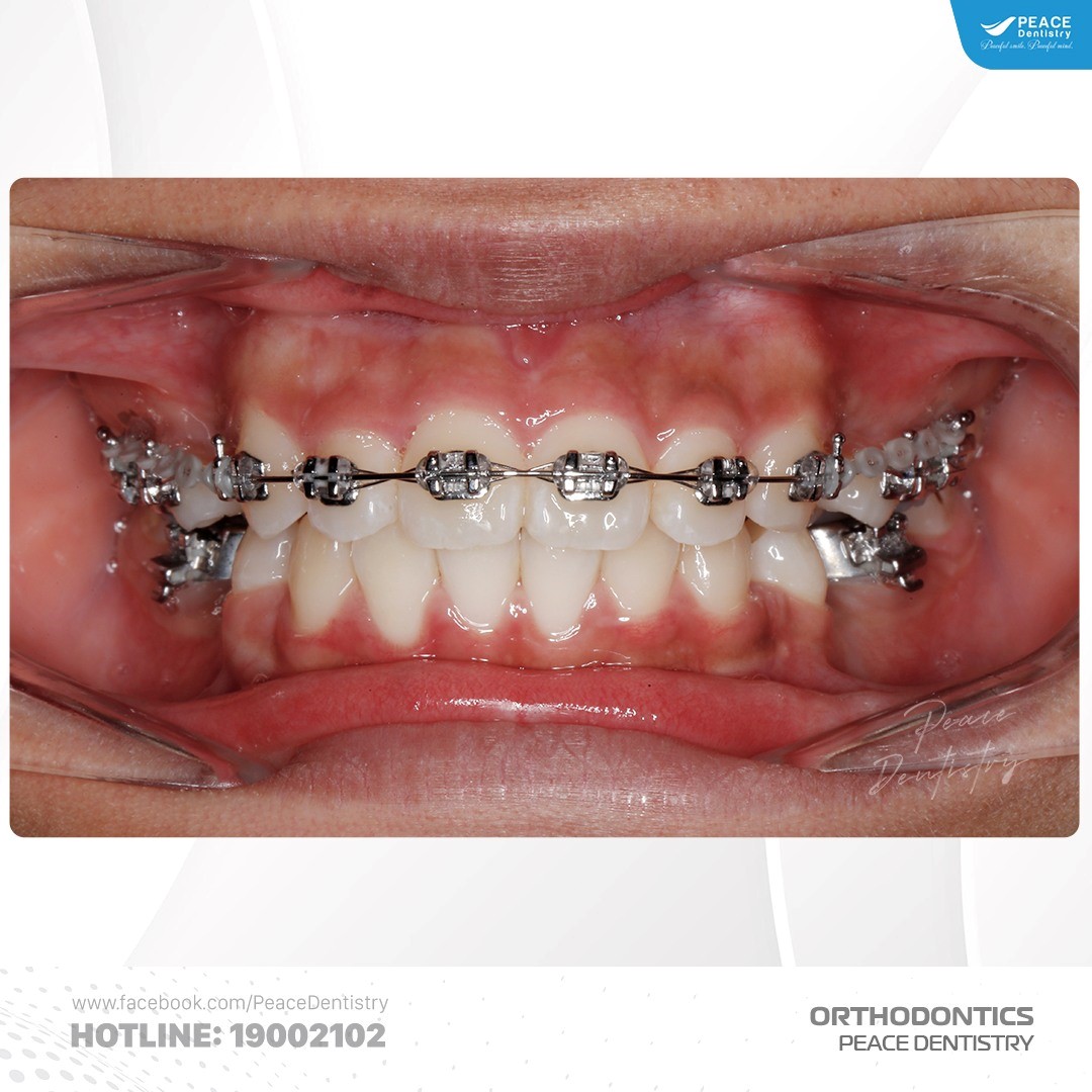 mắc cài kim loại thường