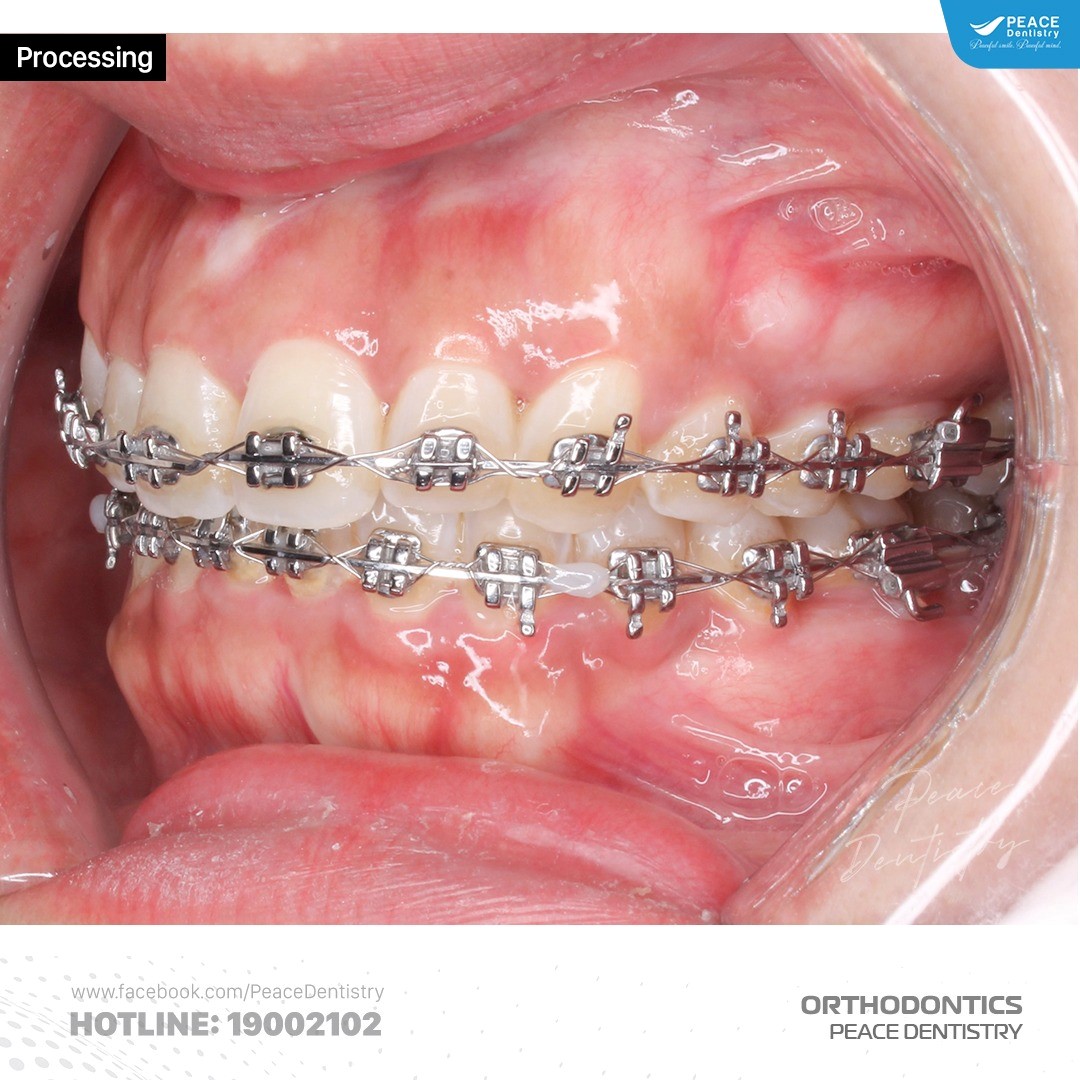 mắc cài kim loại tự buộc