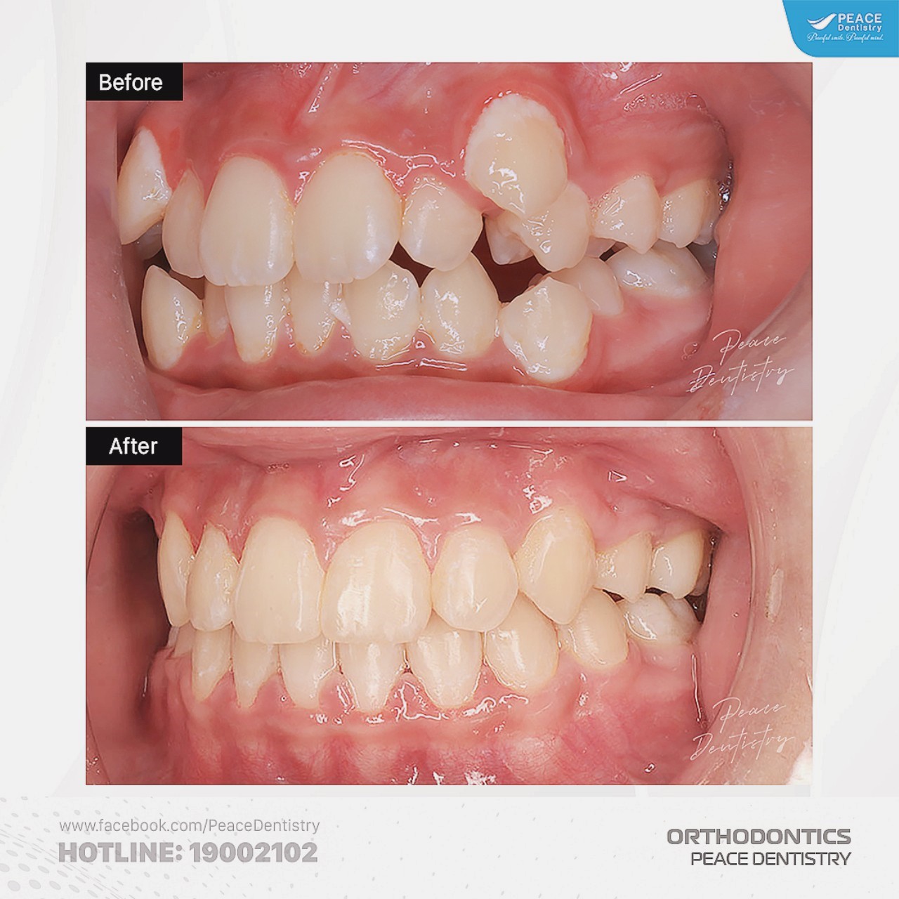 niềng răng mắc cài sứ cho răng khấp khểnh