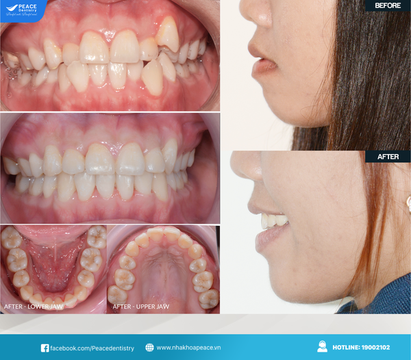 niềng răng mắc cài sứ cho răng mọc lệch