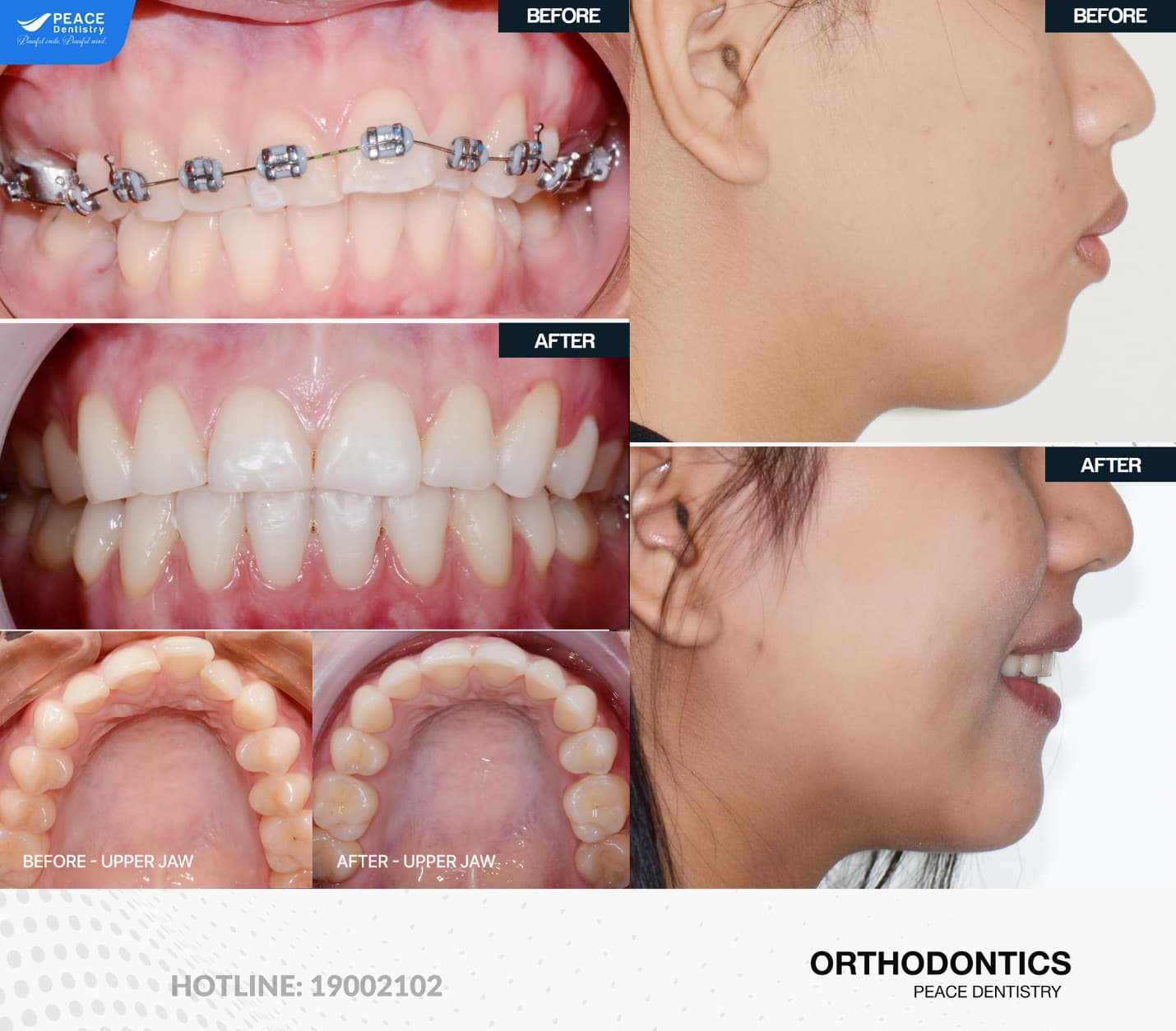 ưu nhược điểm mắc cài kim loại thường