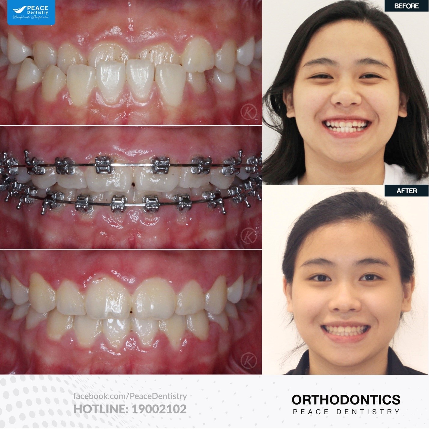 ưu nhược điểm mắc cài kim loại tự buộc