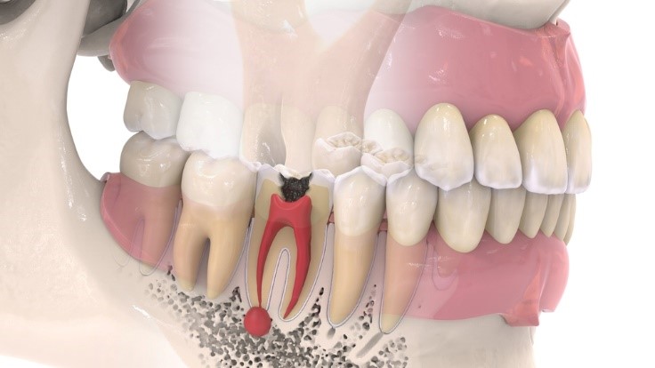 bà bầu bị viêm tủy răng