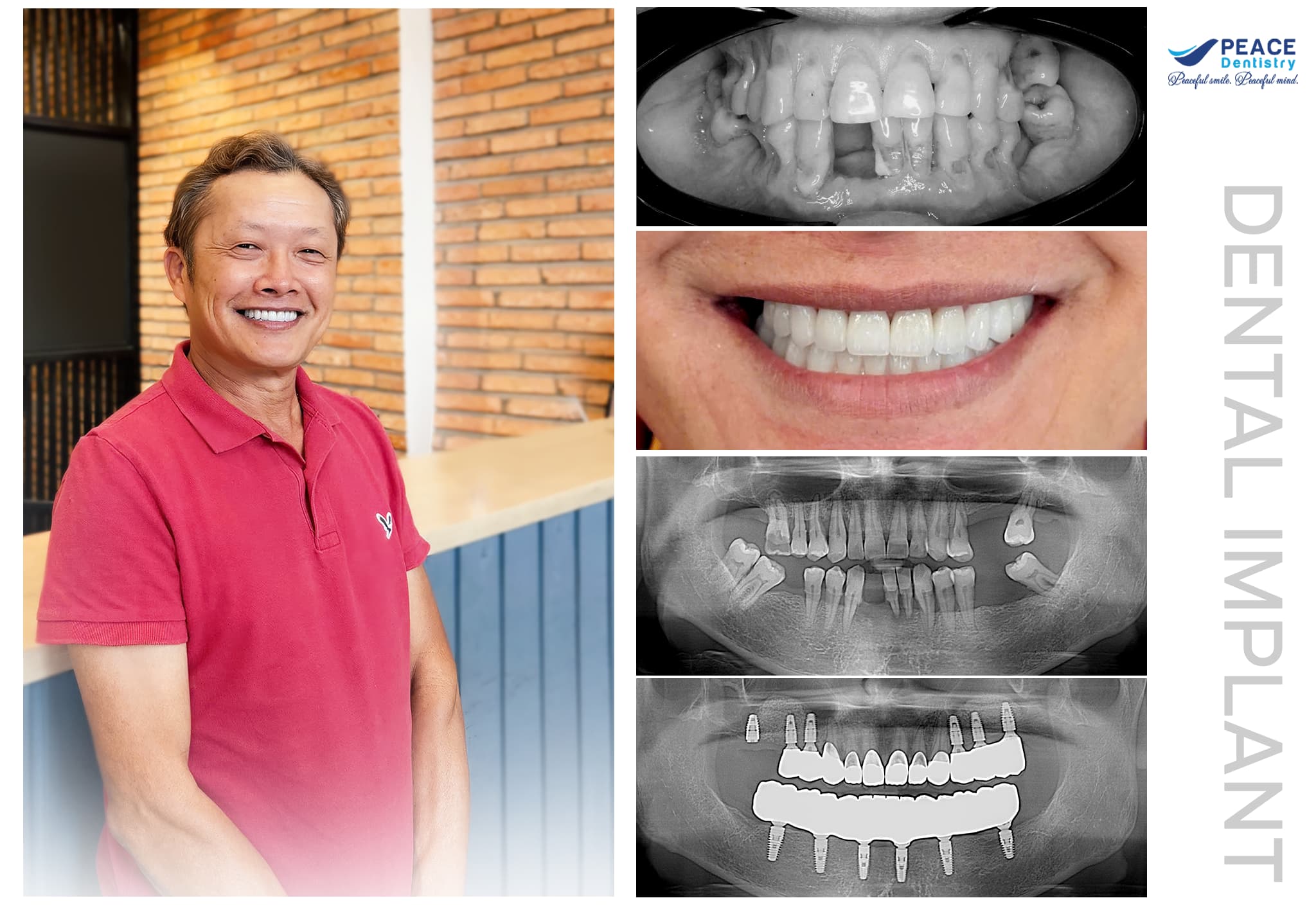 ca lâm sàng trồng răng implant all on 6 cho khách hàng 57 tuổi