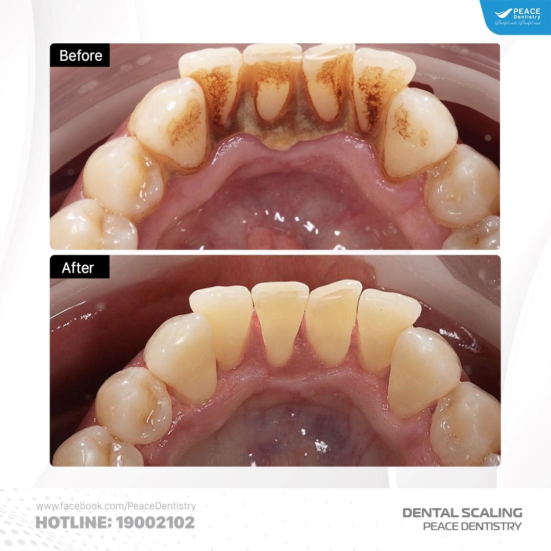 cạo vôi răng chữa bệnh nha chu