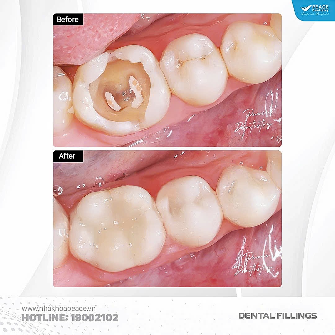 chữa tủy răng bao lâu