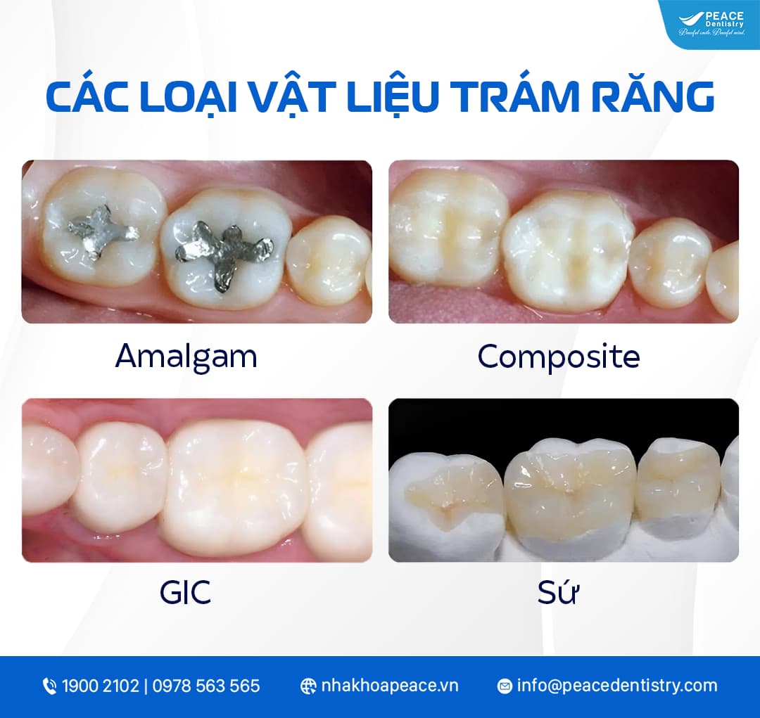 giá trám răng vĩnh viễn