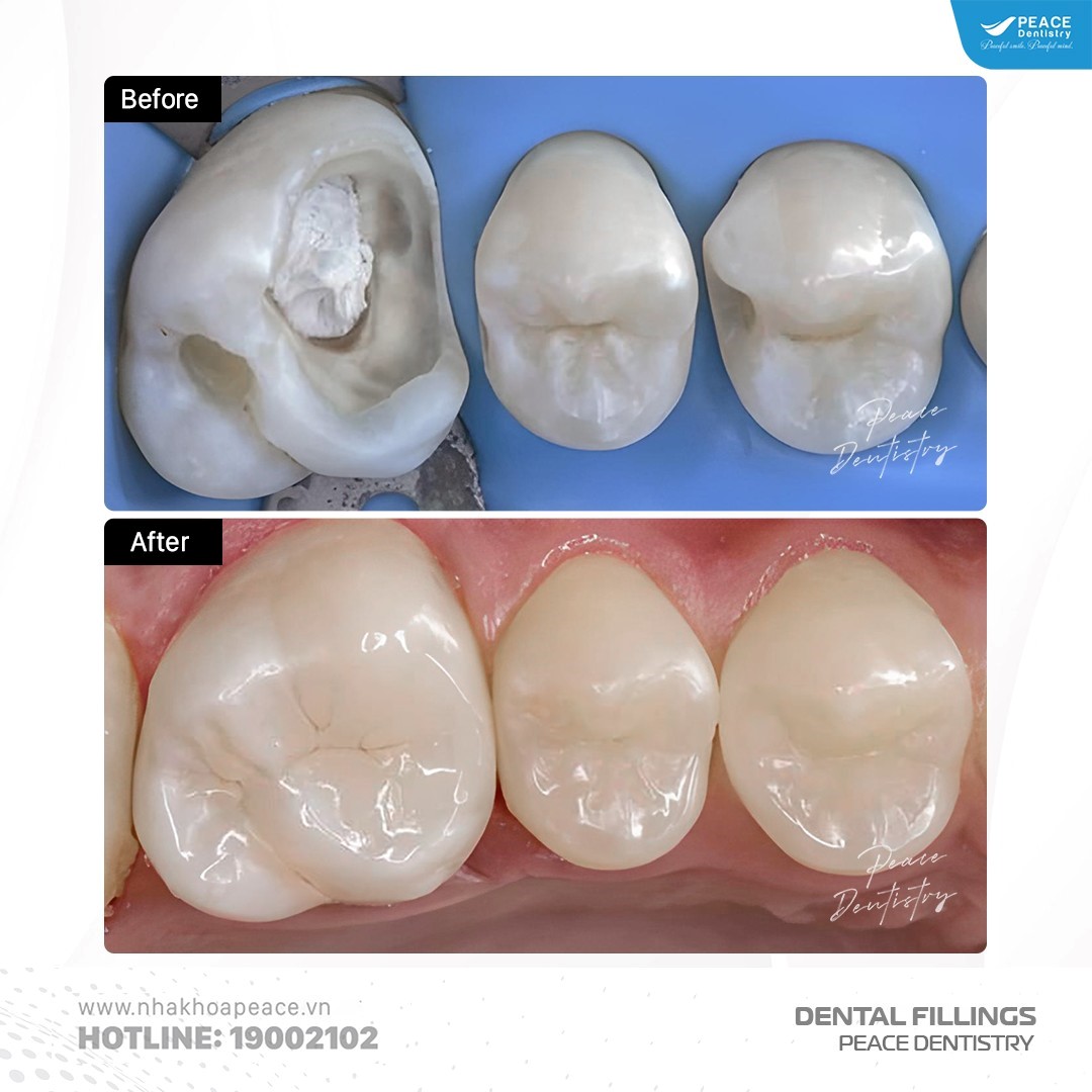 hình ảnh trám răng vĩnh viễn tại peace dentistry