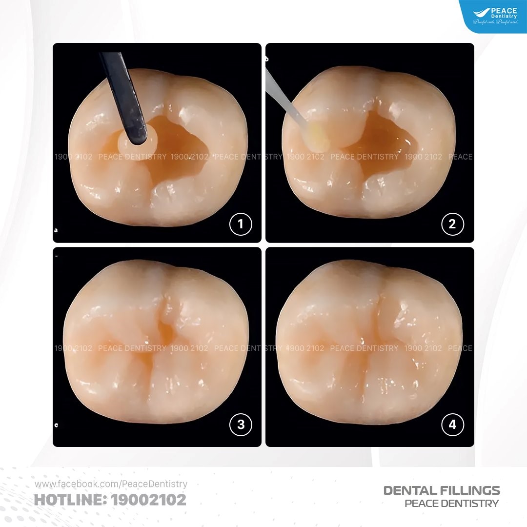 lợi ích của việc trám răng