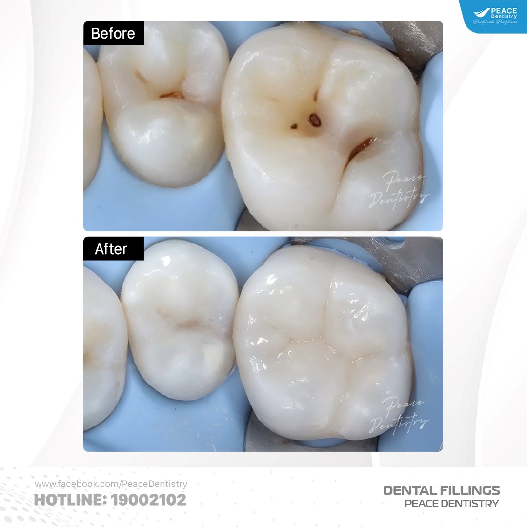 trám răng composite