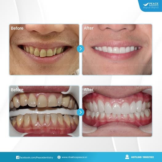 bọc răng sứ có bị hôi miệng không