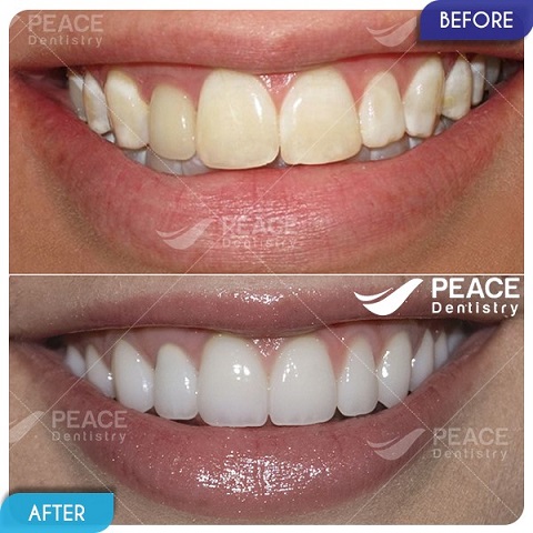 bọc sứ cho răng nhiễm kháng sinh tetra