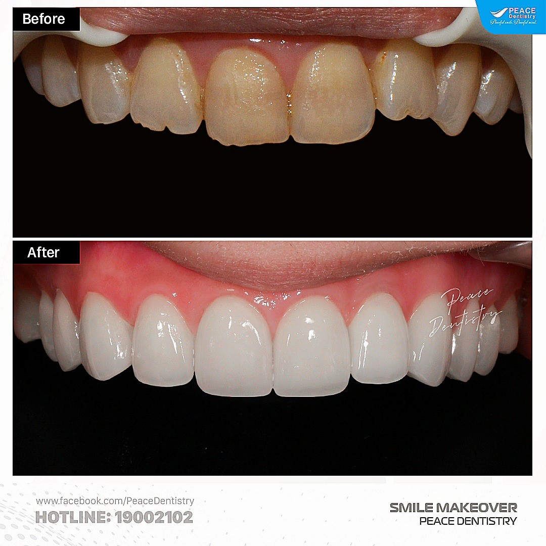 các trường hợp bọc răng sứ