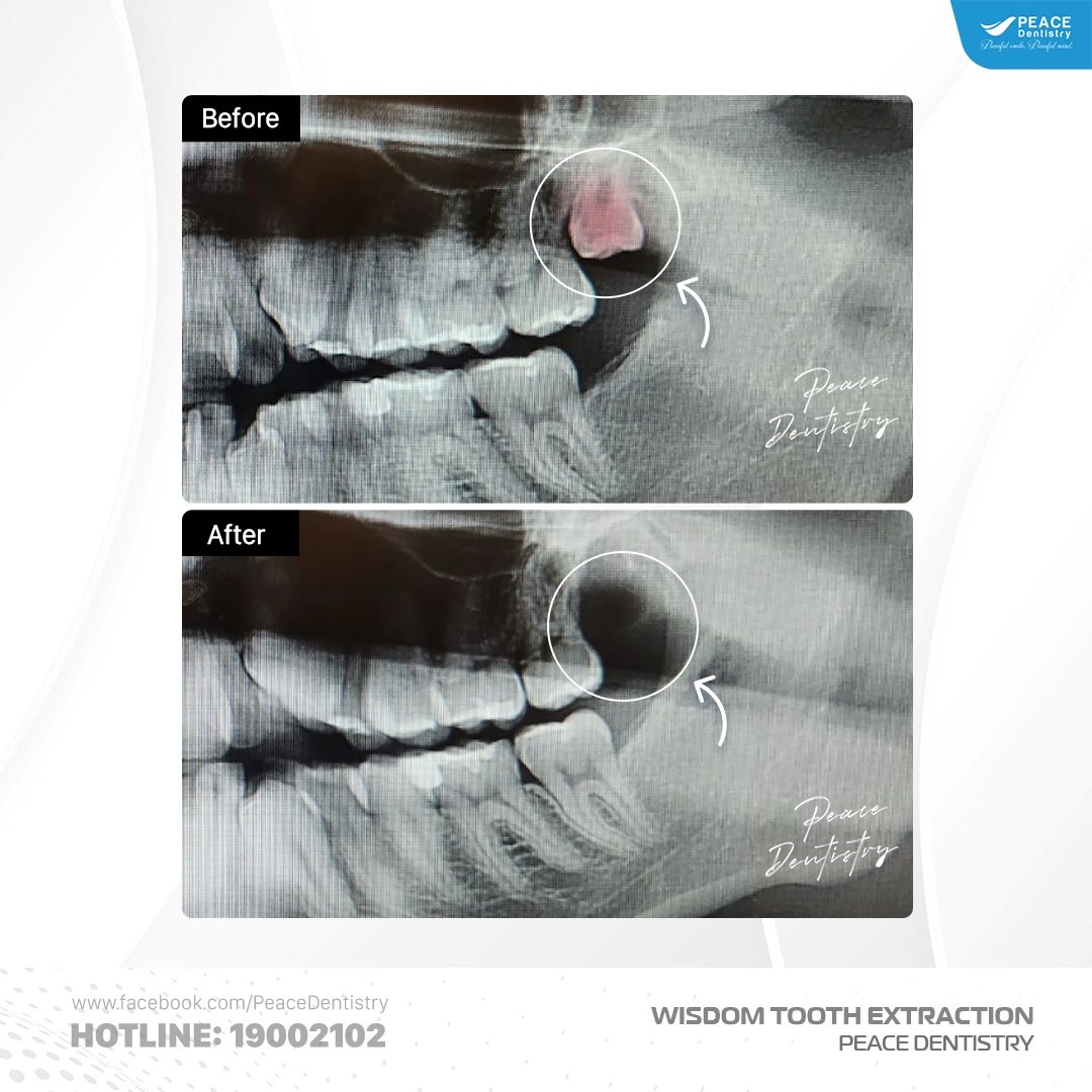 cách trị hôi chân răng tại nha khoa