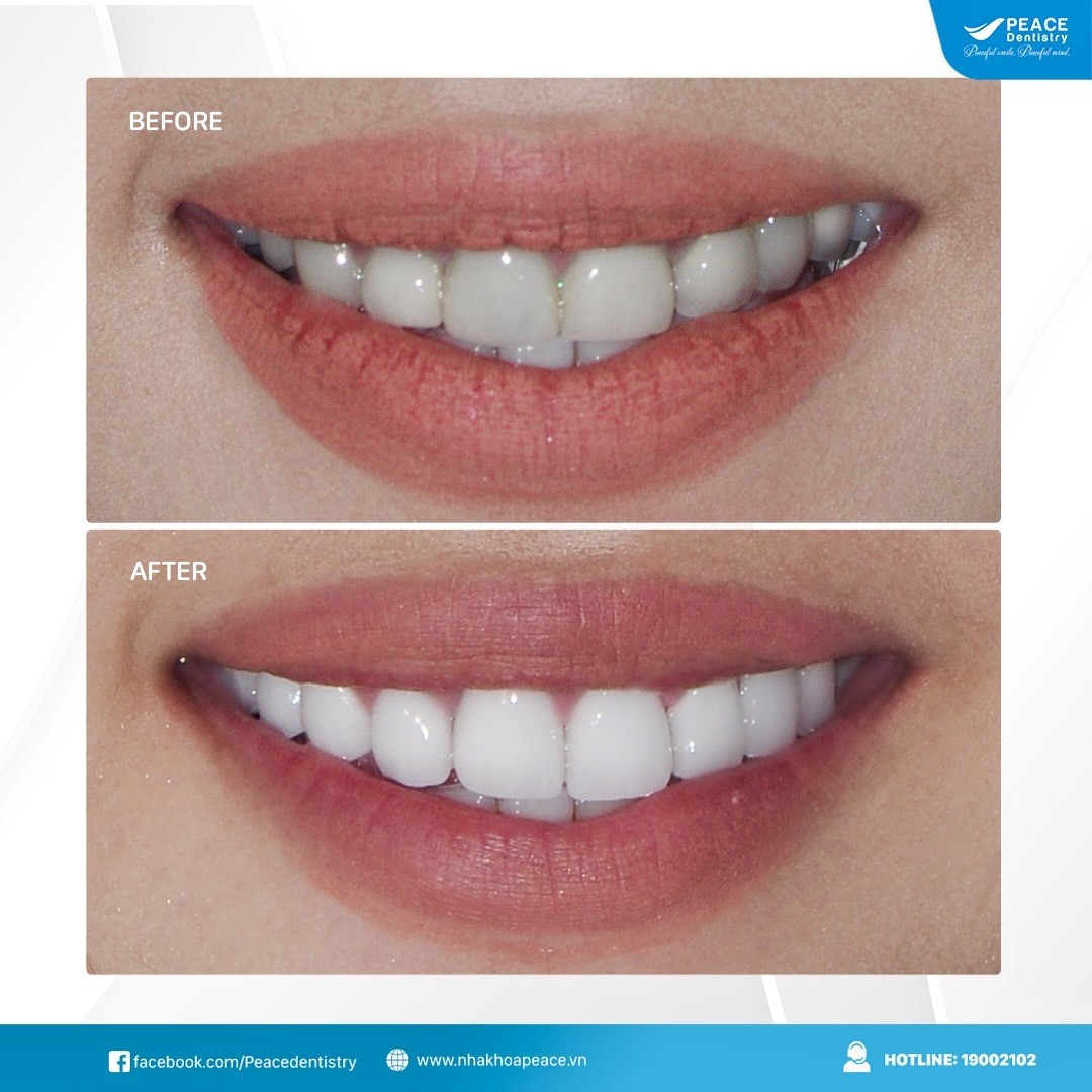 cách trị hôi miệng sau khi bọc sứ