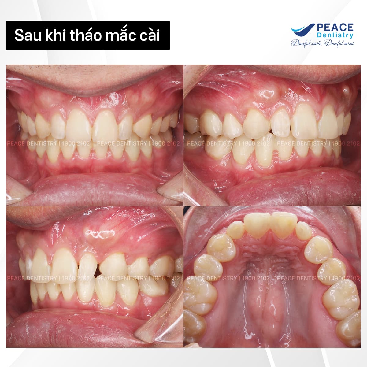 case niềng răng kết hợp dán sứ veneer hình ảnh sau khi tháo mắc cài