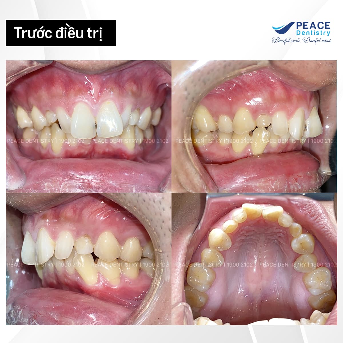 case niềng răng kết hợp dán sứ veneer hình ảnh trước khi điều trị