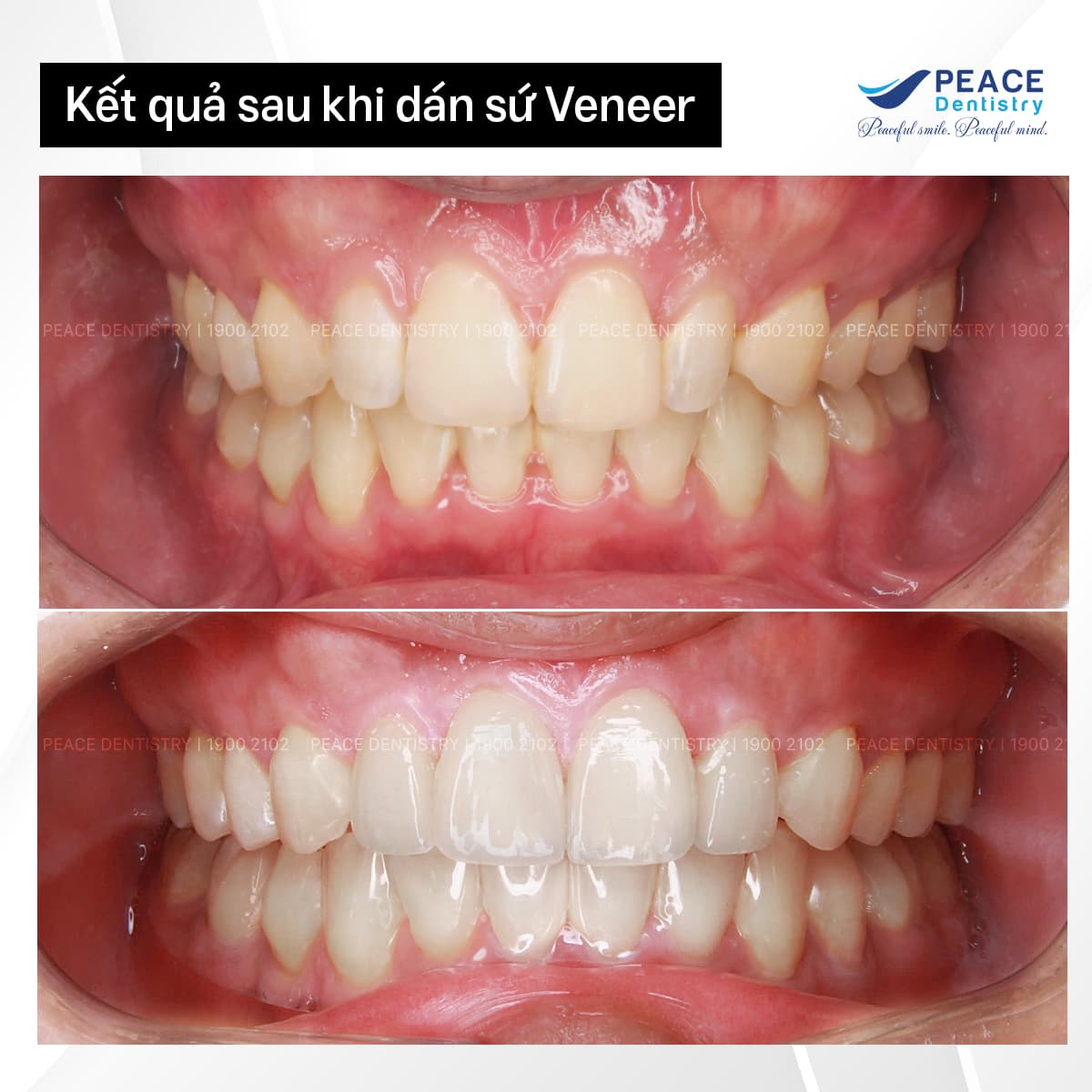 case niềng răng kết hợp veneer hình ảnh sau khi dán sứ