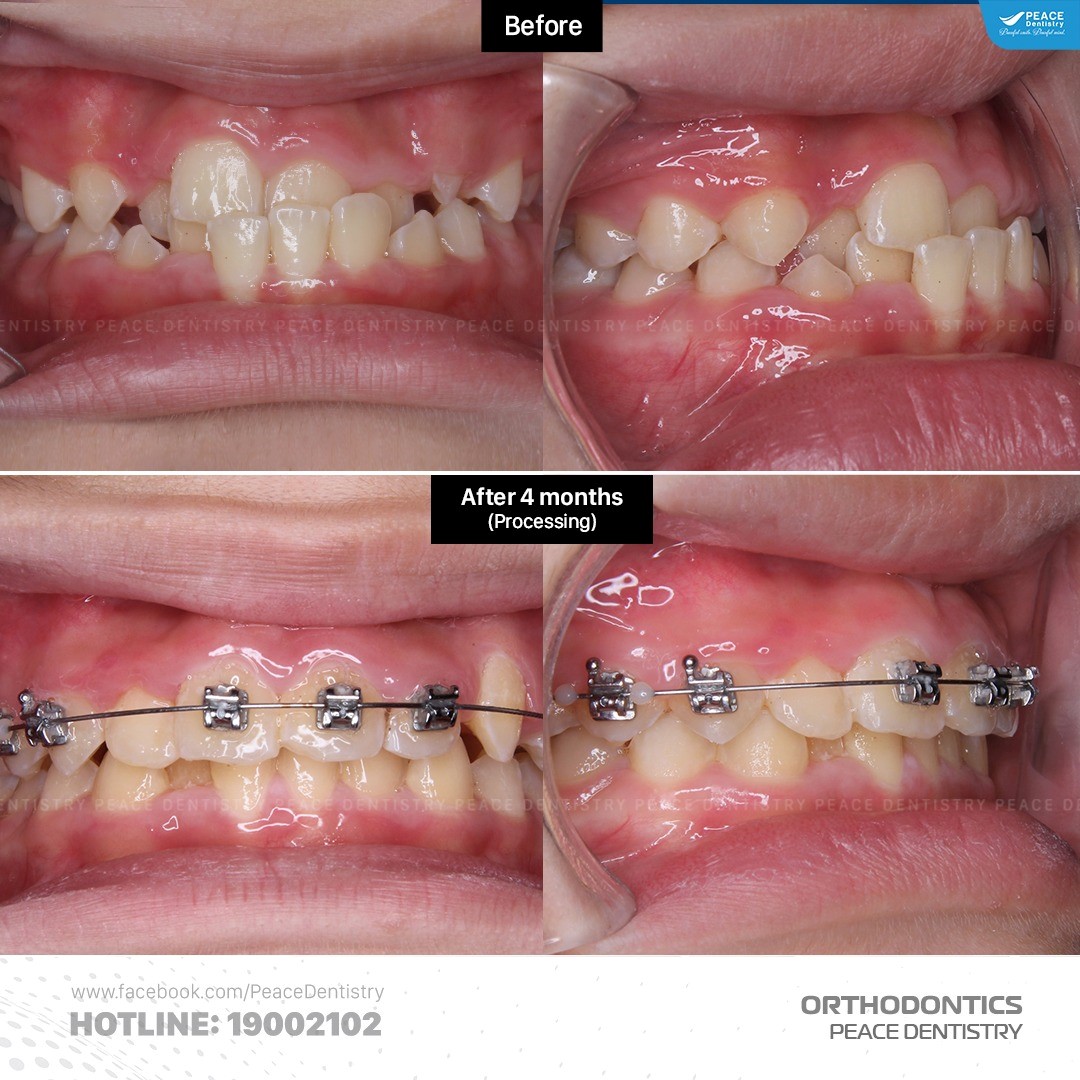 chi phí niềng răng móm hết bao nhiêu