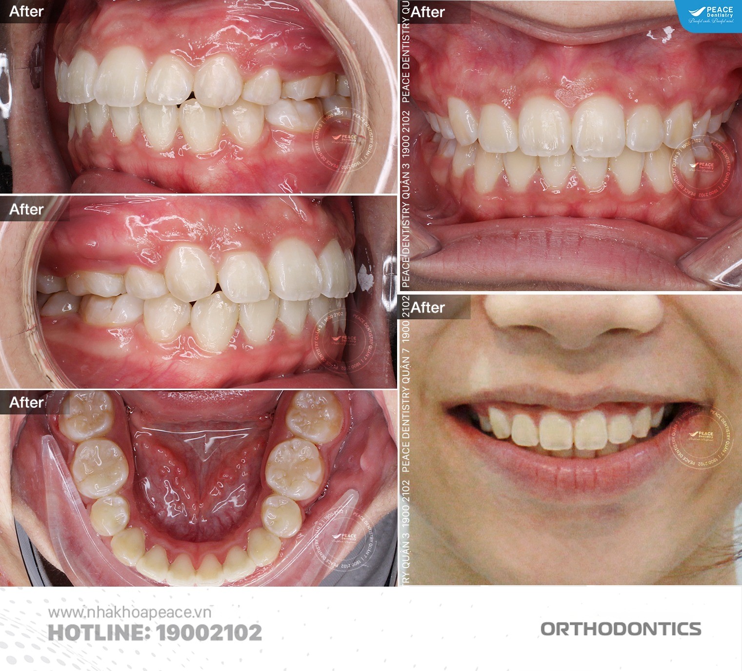 chi phí niềng răng móm