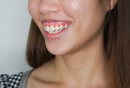 cười hở lợi do nguyên nhân nào