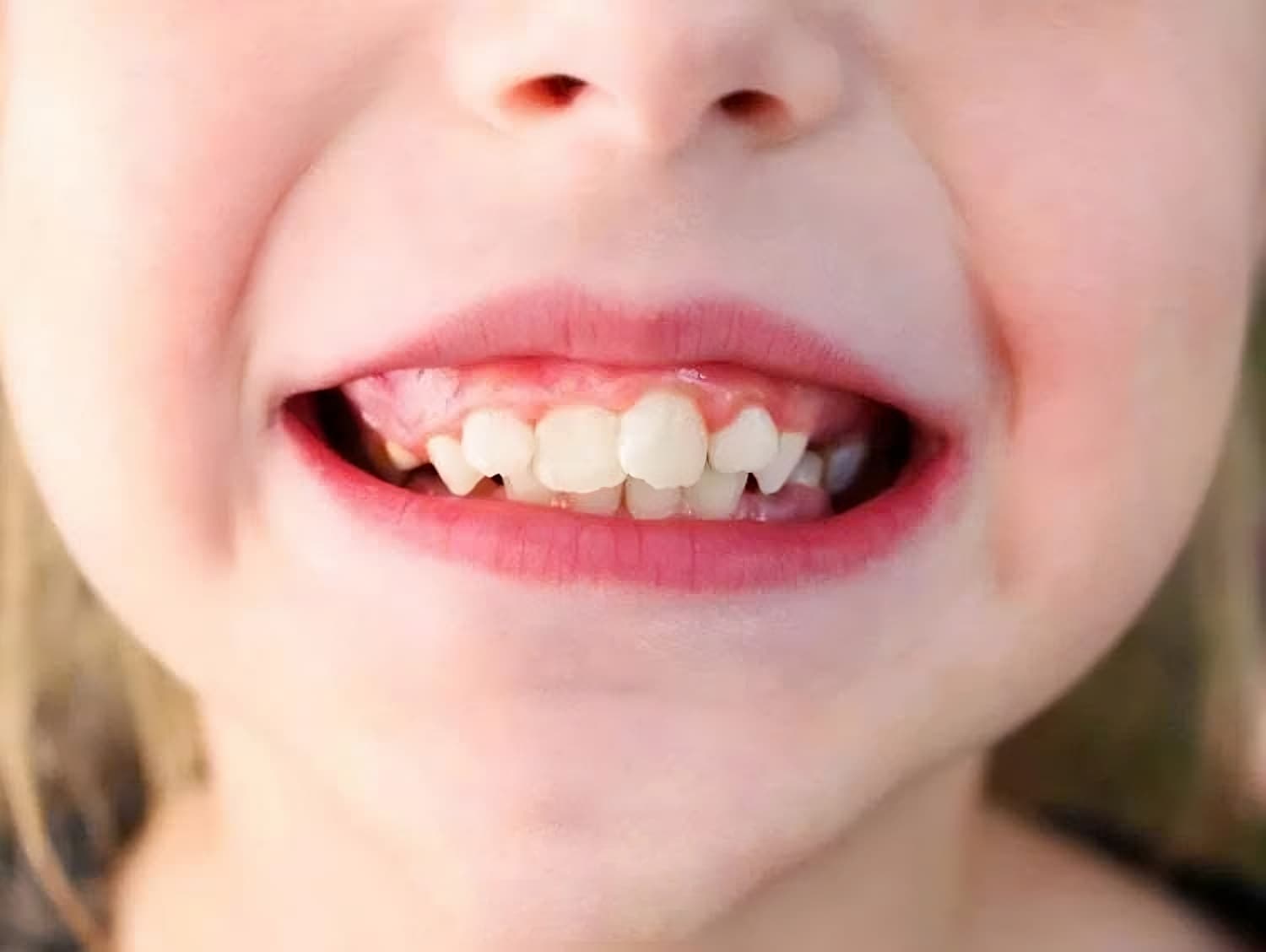 cười hở lợi ở trẻ em