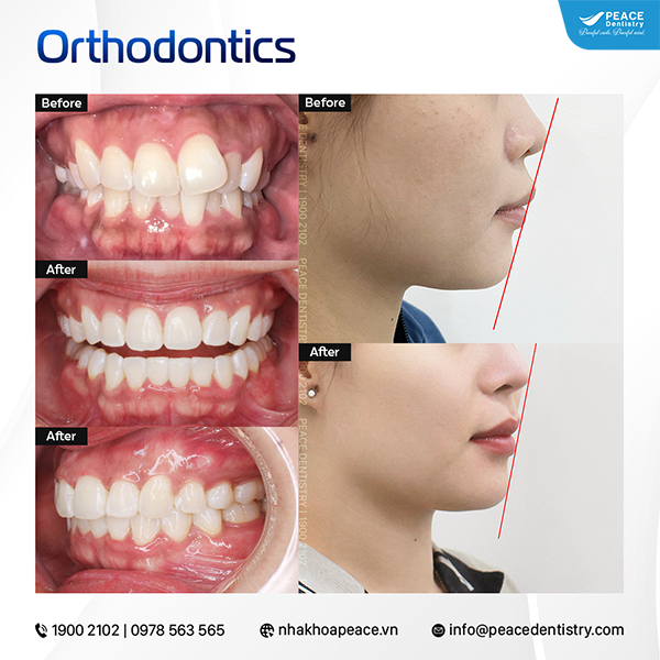 góc nghiêng trước và sau khi niềng răng