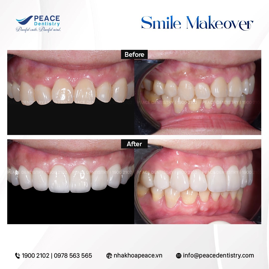 hình ảnh cắt nướu làm dài thân răng kết hợp dán sứ veneer