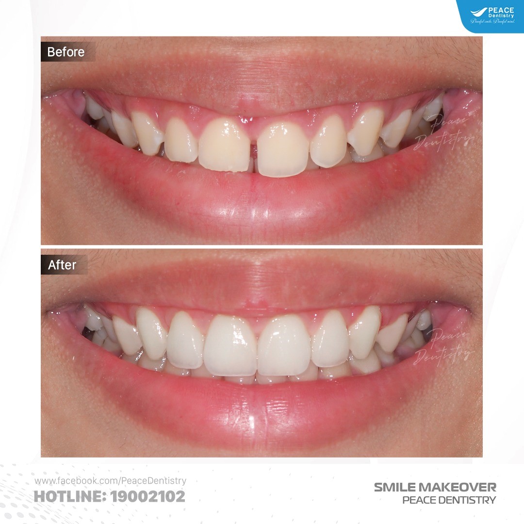 hình ảnh cắt nướu laser kết hợp dán sứ veneer