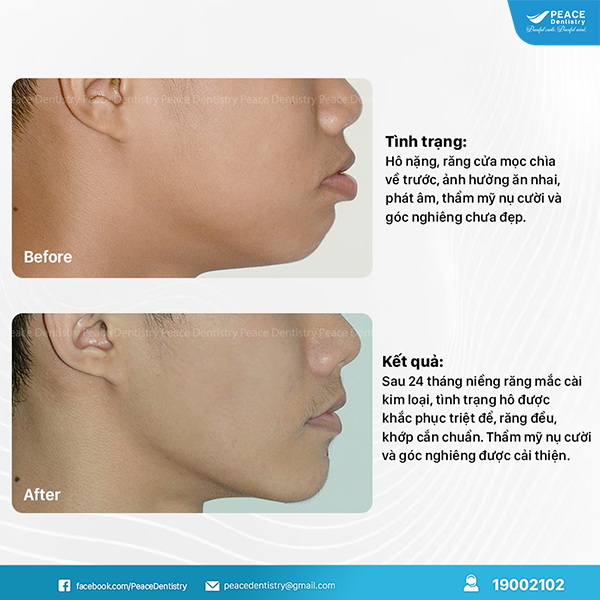hình ảnh kết quả sau khi niềng răng tại peace dentistry