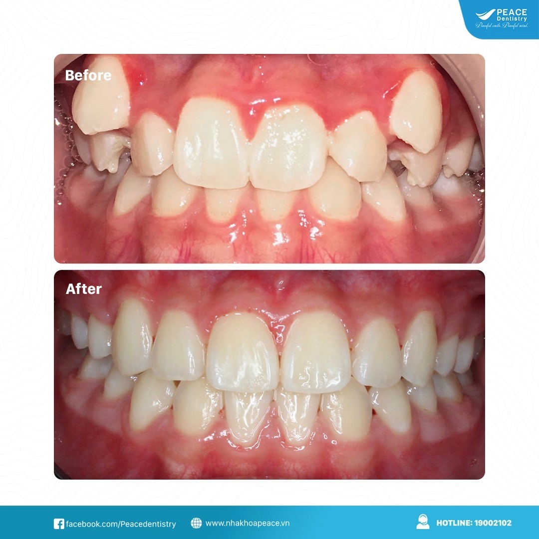 hình ảnh khách hàng niềng răng hô sau 23 tháng tại peace dentistry