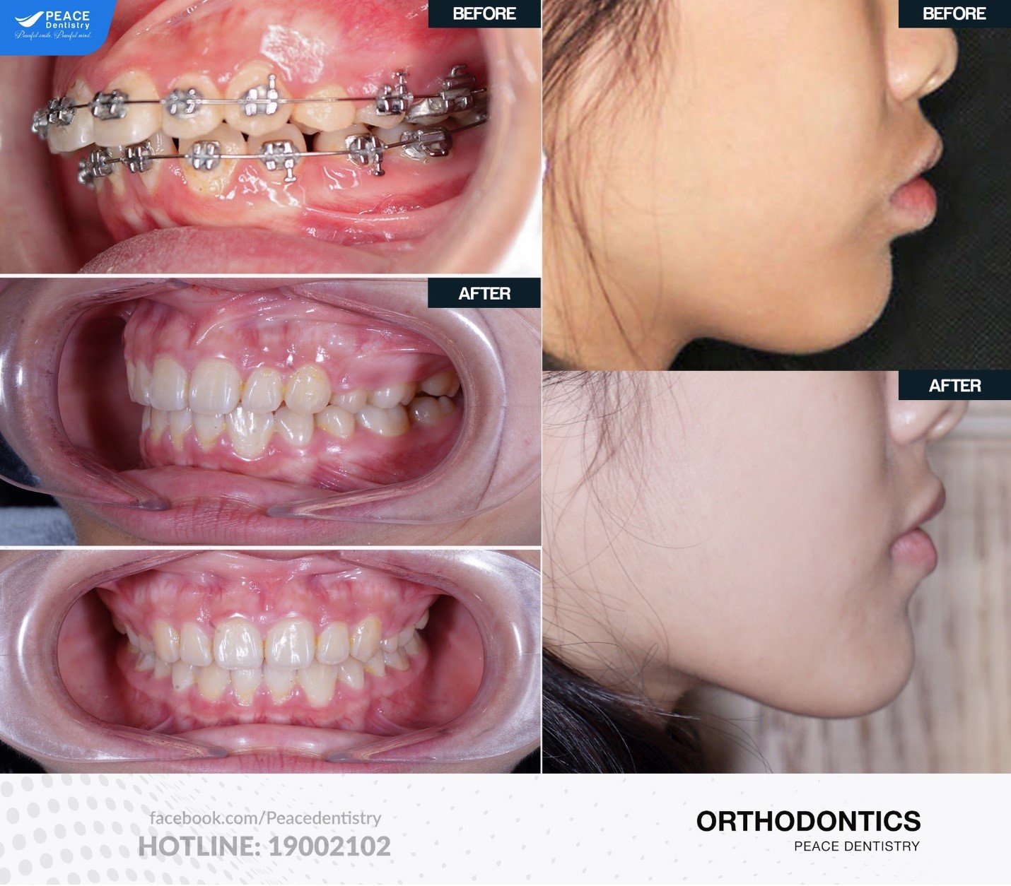 hình ảnh khách hàng niềng răng hô sau 24 tháng tại peace dentistry