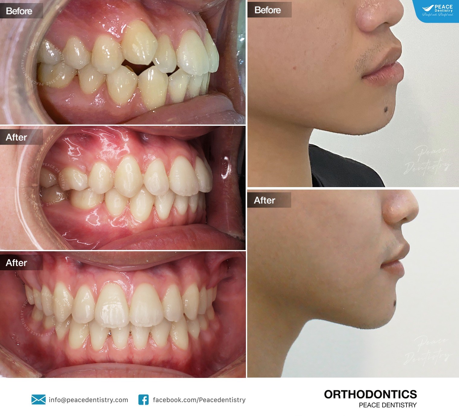 hình ảnh khách hàng niềng răng hô sau 30 tháng tại peace dentistry