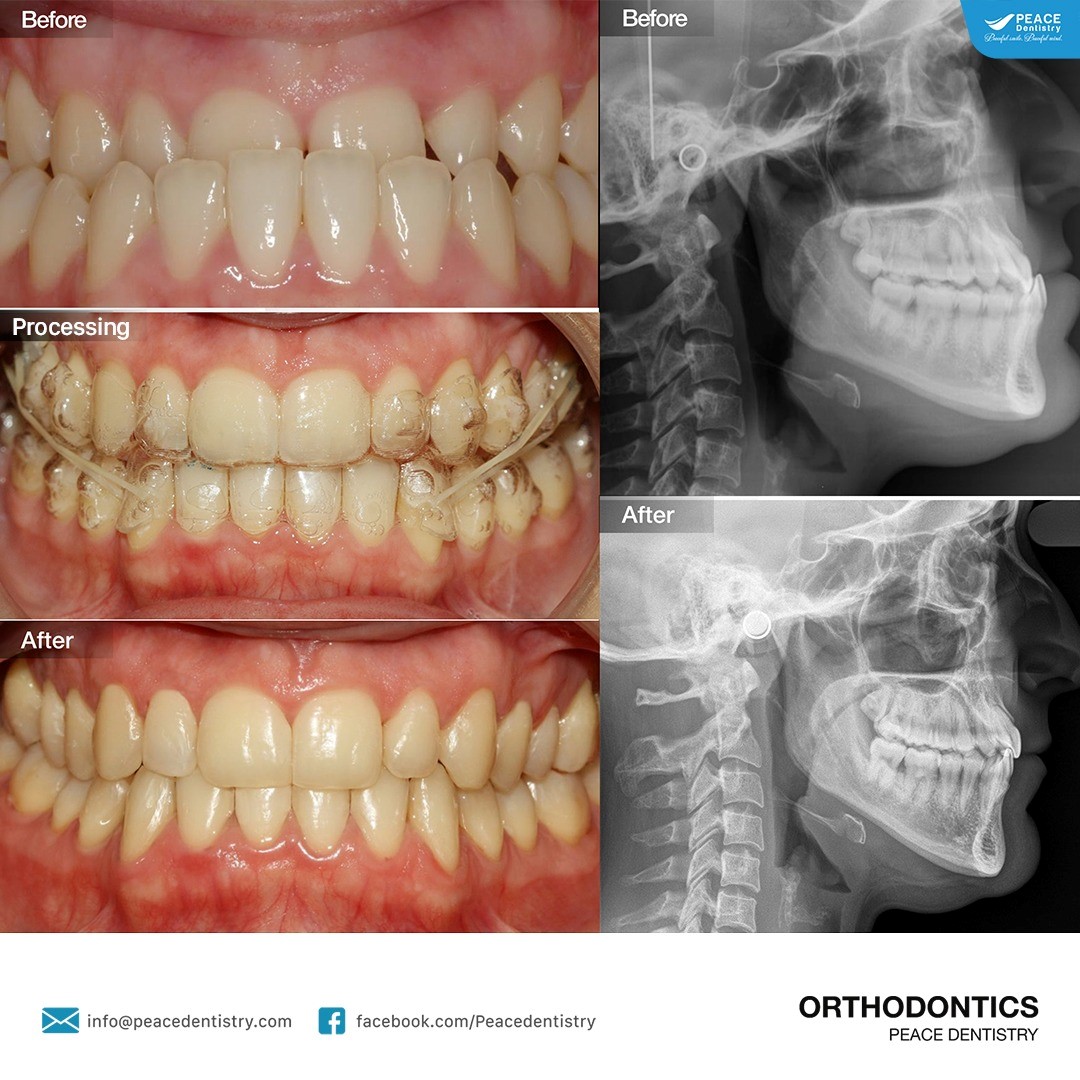 hình ảnh niềng răng móm tại peace dentistry