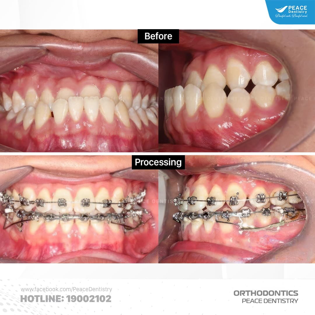 hình ảnh niềng răng móm