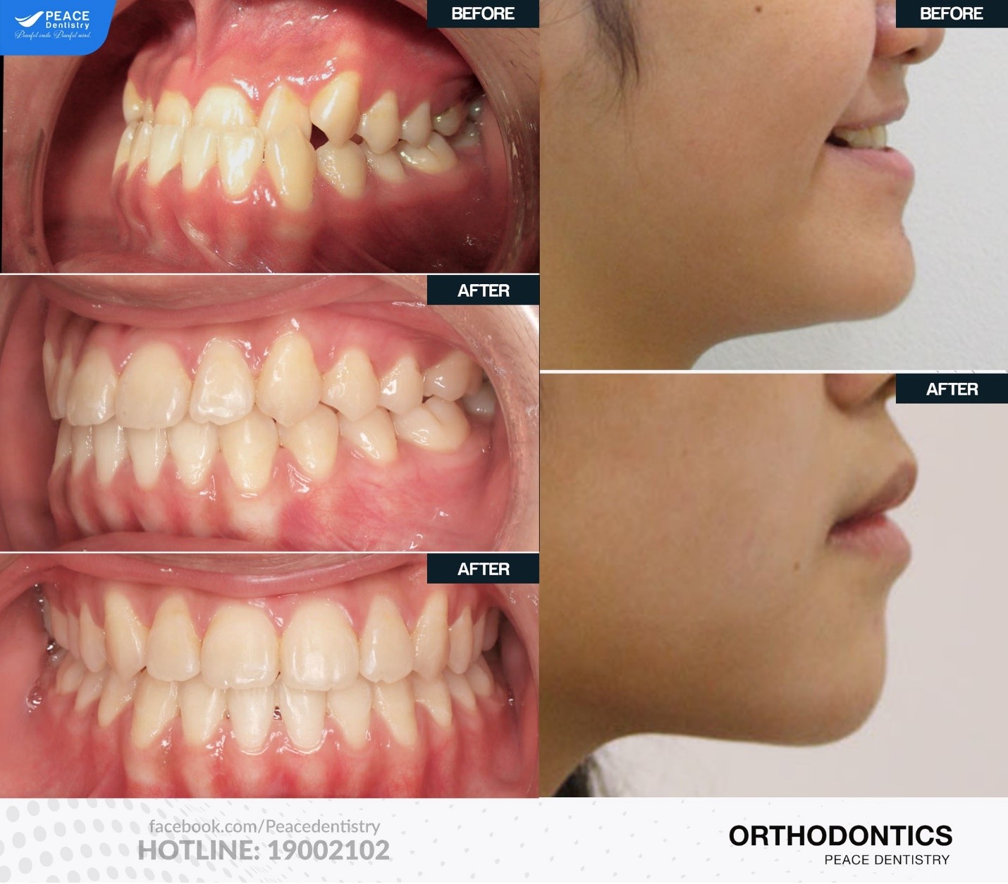 hình ảnh trước và sau khi niềng răng móm tại peace dentistry