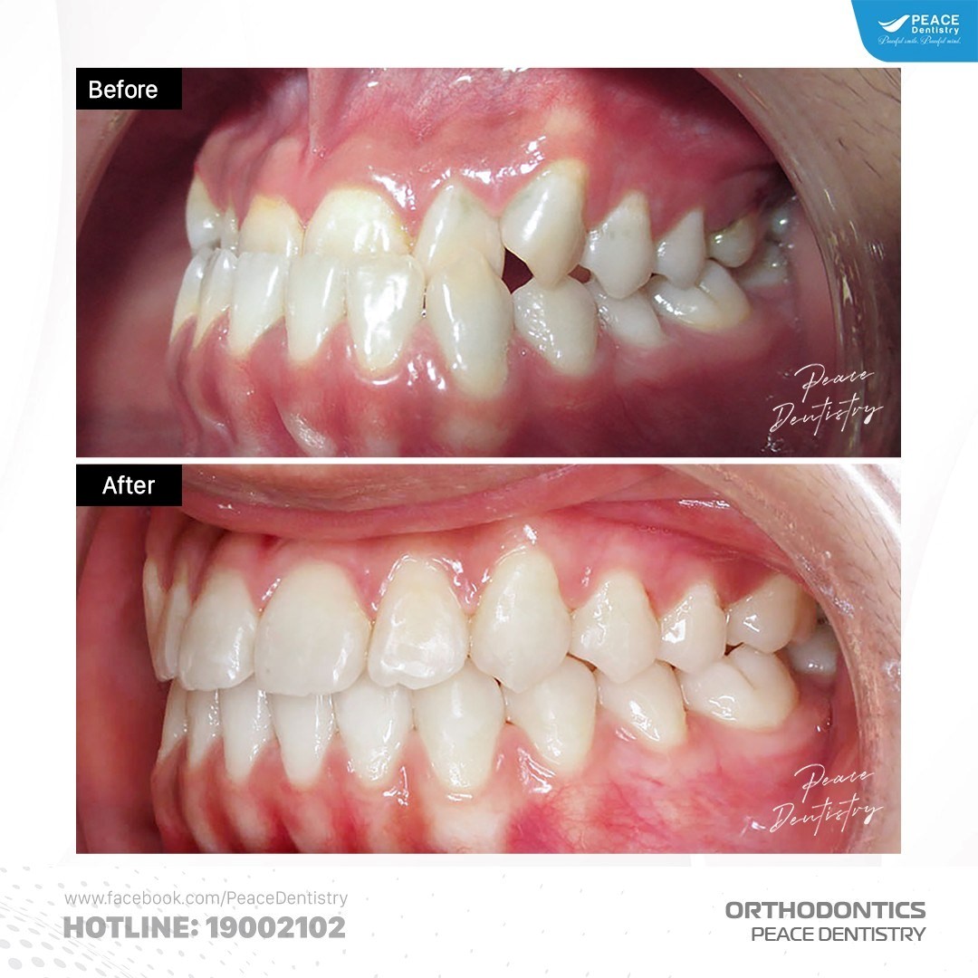 hình ảnh khách hàng niềng răng móm tại peace dentistry
