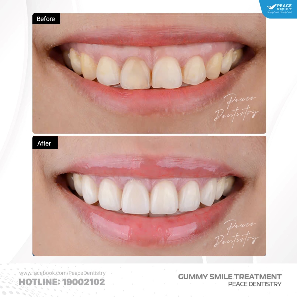 hình ảnh khách hàng sau khi chữa cười hở lợi