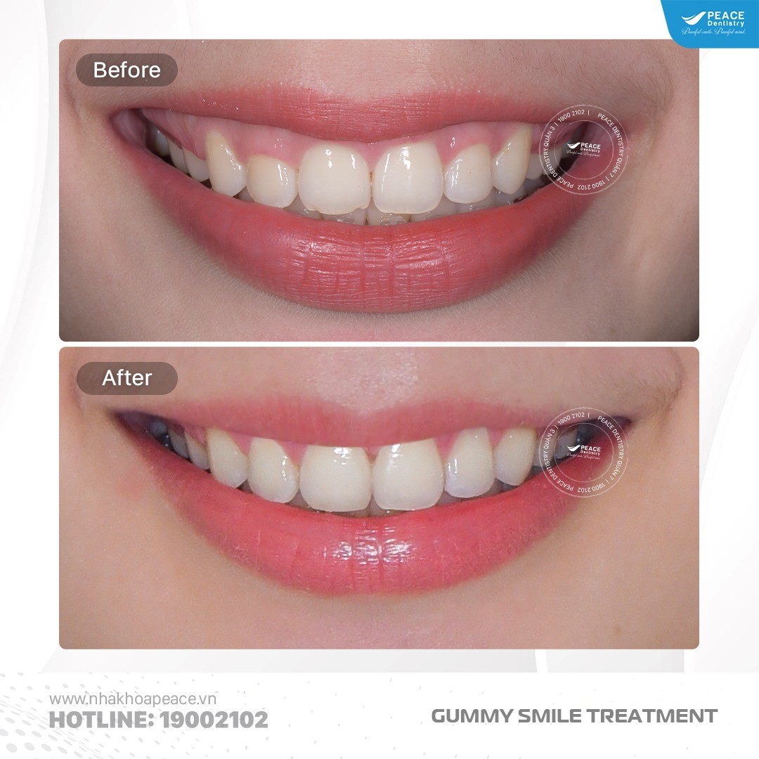 hình ảnh phẫu thuật cười hở lợi có điều chỉnh ổ xương