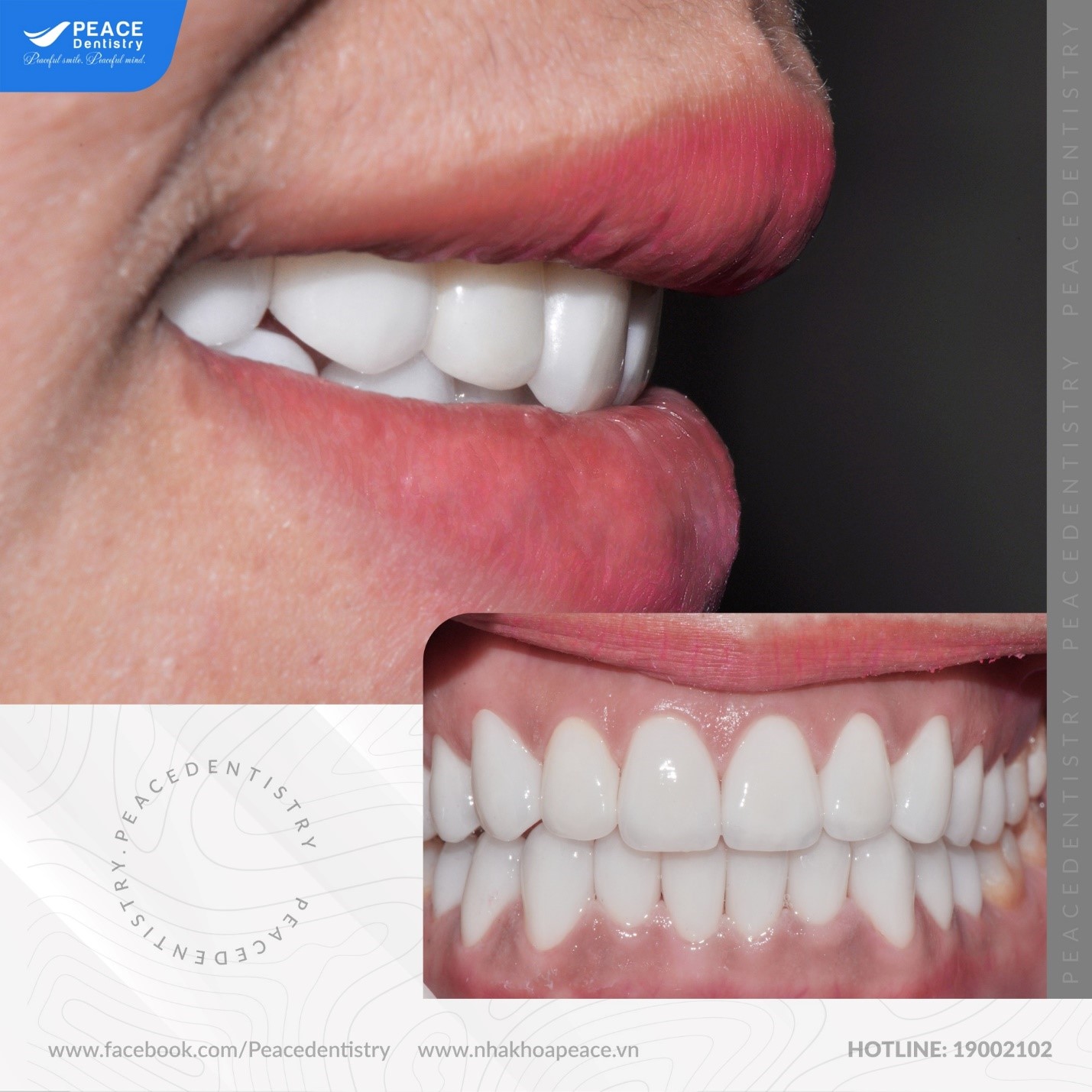 lợi ích khi mài răng bọc sứ đúng cách