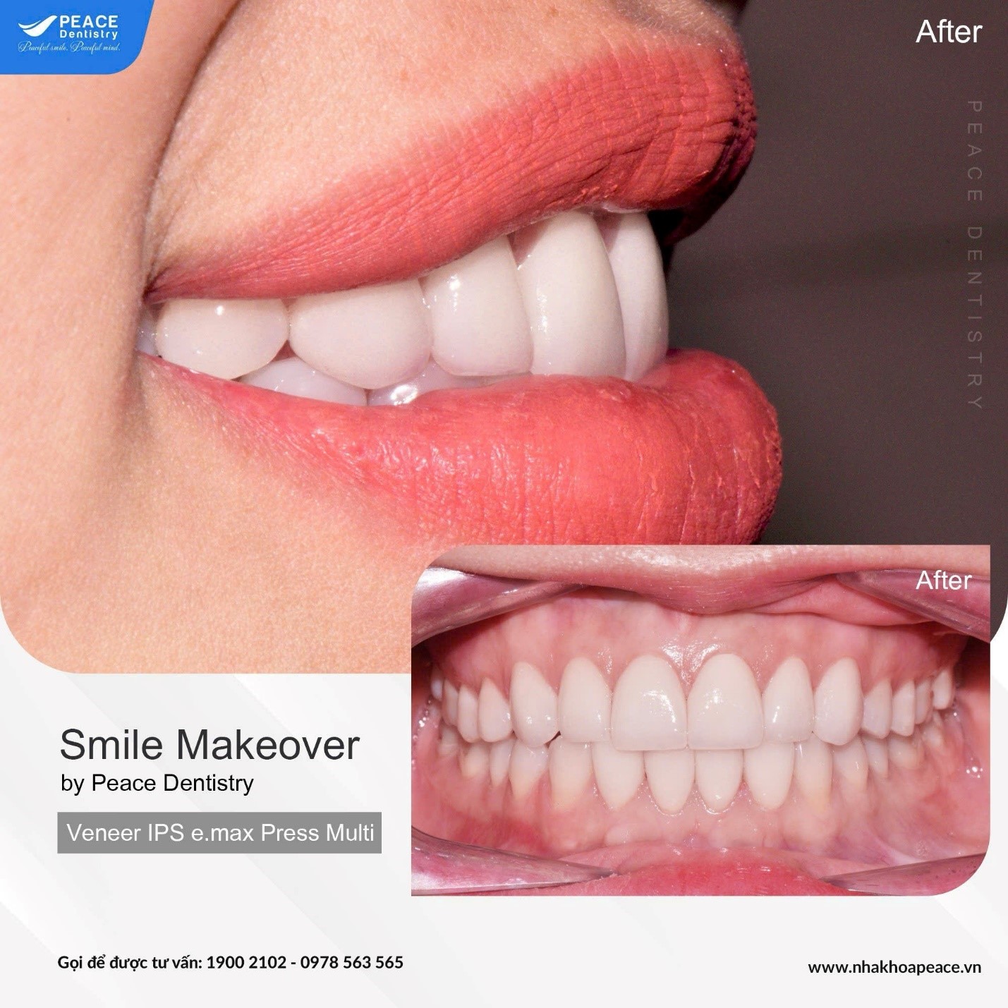 nên bọc sứ hay niềng răng